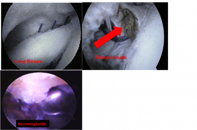 Aspect arthroscopique