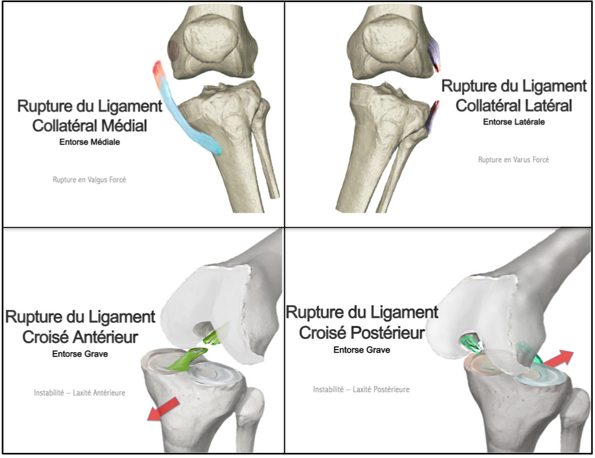 Orthèse de genou ligamentaire