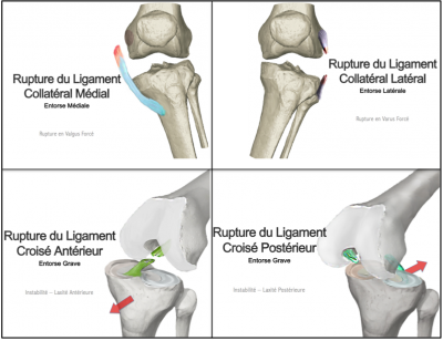 Rupture ligaments croisées, rupture ligaments collatéraux