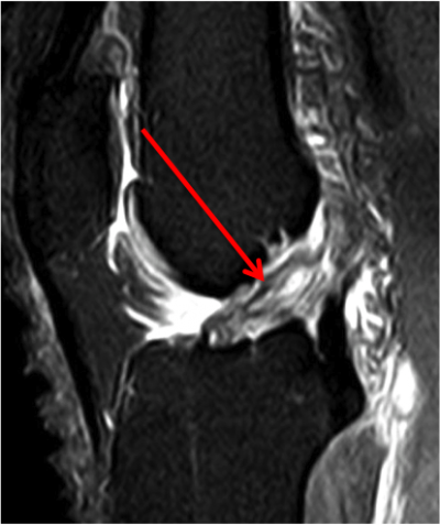 Rupture du LCA: aspect IRM