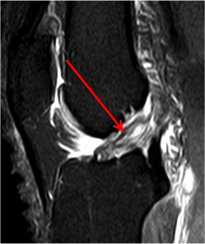 Rupture du ligament croisé antérieur (LCA) - Groupe Clinique Drouot