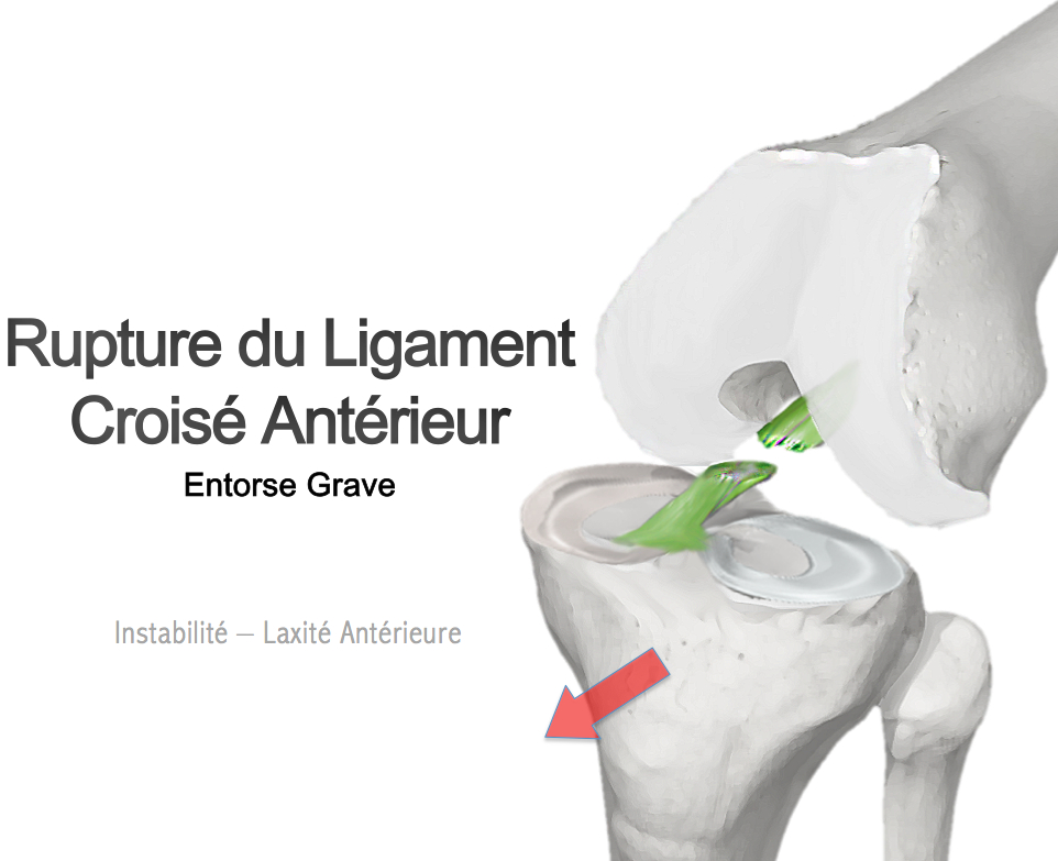 Rupture du ligament croisé antérieur (LCA) - Groupe Clinique Drouot
