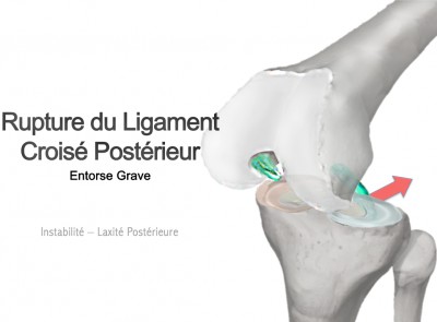 Entorse du Ligament croisé postérieur