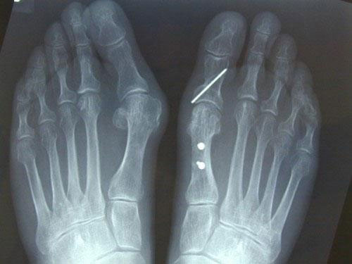 opération hallux valgus