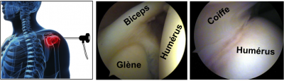 Aspect arthroscopique normal