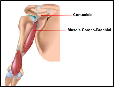 Figure 6 from Récidive d'instabilité glénohumérale après butée  coracoïdienne de type Bristow-Latarjet : quelle place pour les  stabilisations capsulaires arthroscopiques uni et bipolaires ?