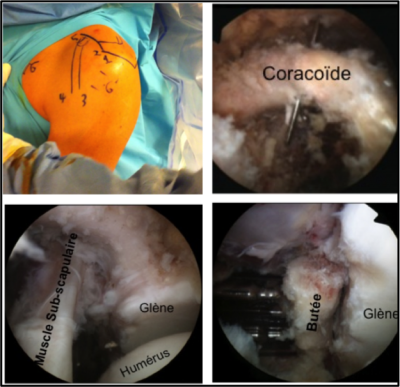 Butée d'épaule: aspect arthroscopique