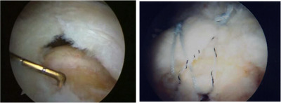 Rupture tendineuse: aspect arthroscopique avant et après réparattion.