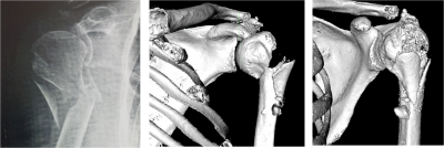Fracture d'épaule: aspect radiographique et scanner