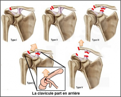 Classification des luxation acromio-claviculaire (Rockwood)