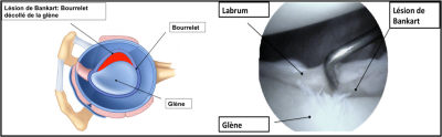 Lésion de Bankart: Schéma et aspect arthroscopique