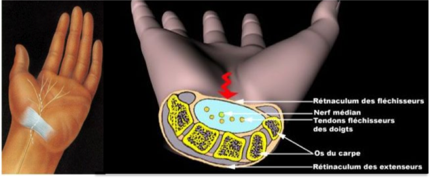 Syndrome du Canal Carpien - Groupe Clinique Drouot