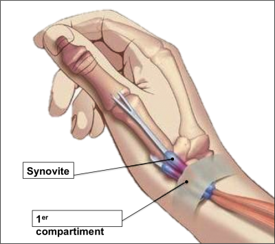 Tendinite du pouce au premier compartiment