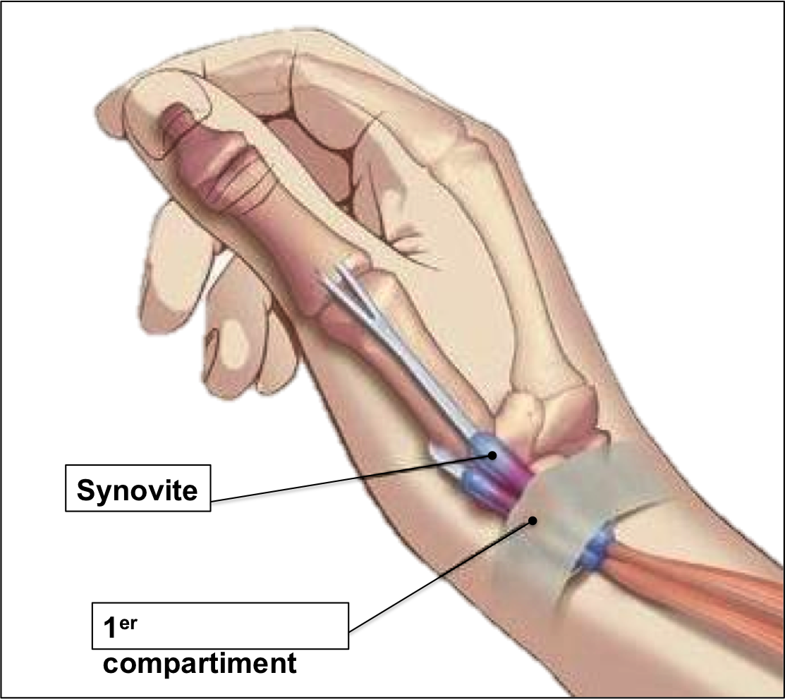 Tendinite du poignet : causes, symptômes et traitements
