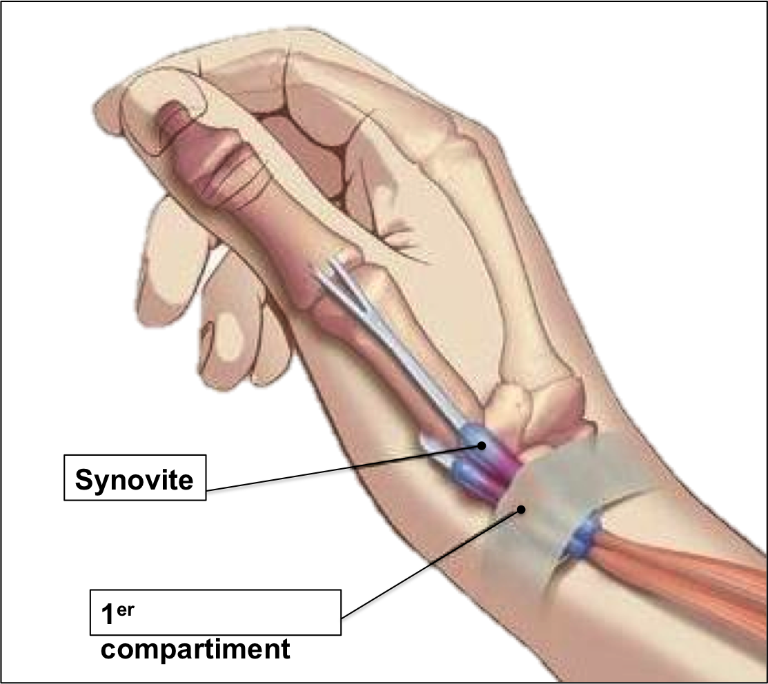 Tendinite du Pouce ou Ténosynovite de De Quervain - Groupe Clinique Drouot