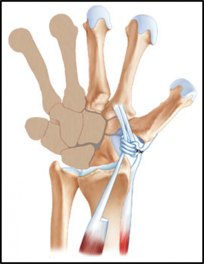 Rizarthrose: Ligamentoplastie au FCR