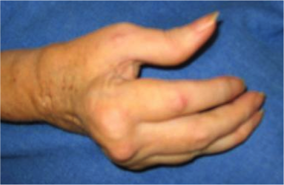 Rhizarthrose ou arthrose du pouce - Groupe Clinique Drouot