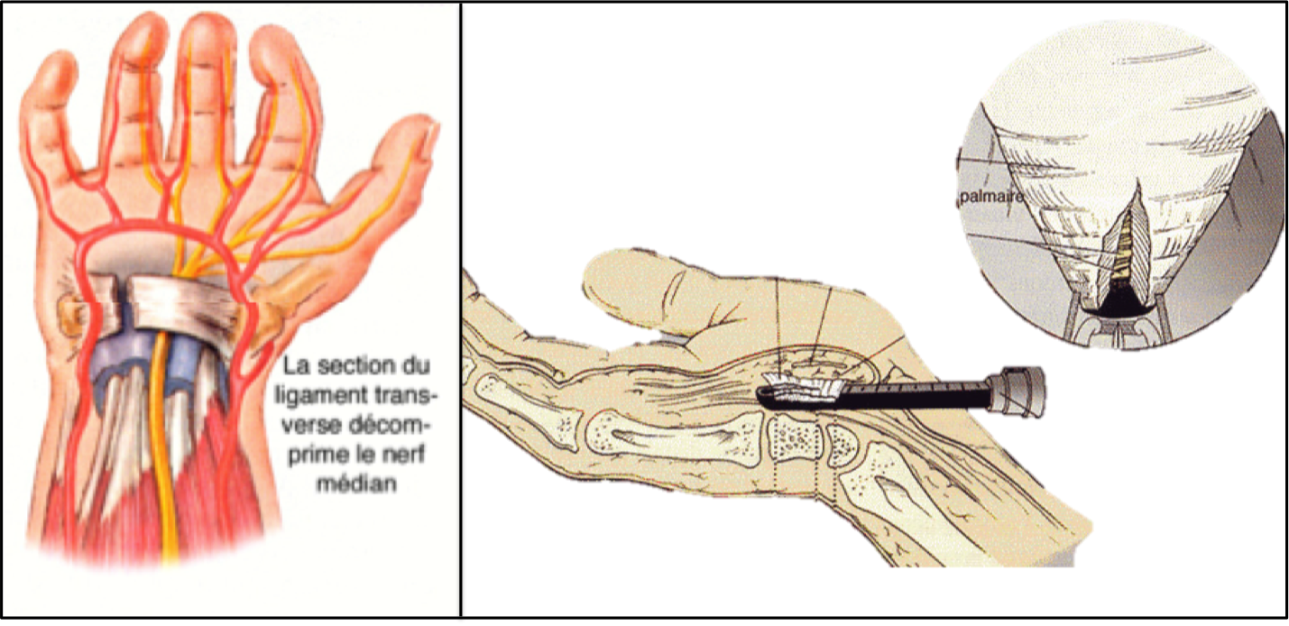 Chirurgie du canal carpien - Groupe Clinique Drouot