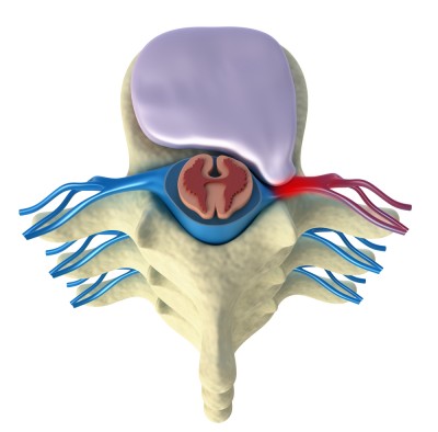 Compression d'une racine par une hernie discale