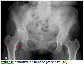 arthrose de hanche