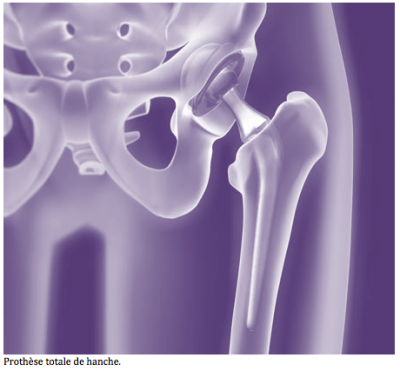 COXARTHROSE3