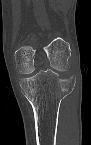 Qu'est ce qu'une fracture du plateau tibial ? - Groupe Clinique Drouot