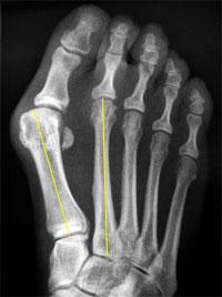 Radiographie Hallux valgus