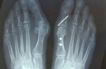 opération hallux valgus