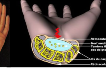 Compression du nerf médian dans le canal carpien