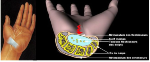 Compression du nerf médian dans le canal carpien