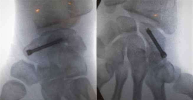 Suite De Fracture En 3 Lettres