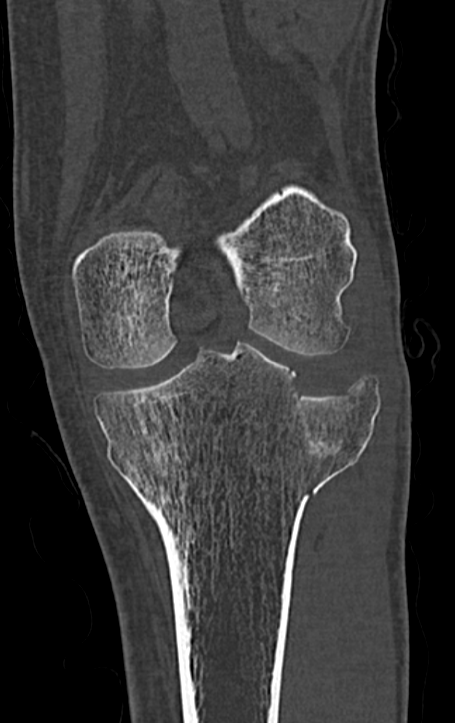 Qu'est ce qu'une fracture du plateau tibial ? - Groupe Clinique Drouot