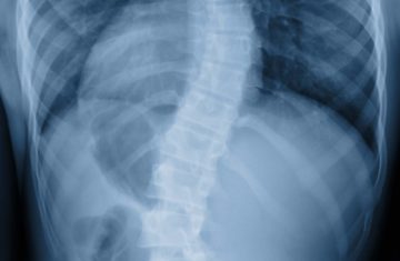 scoliose radiographie