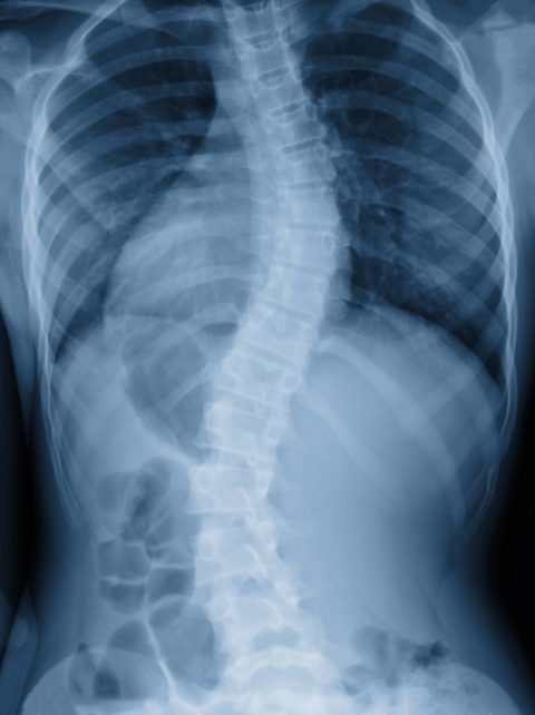 scoliose radiographie