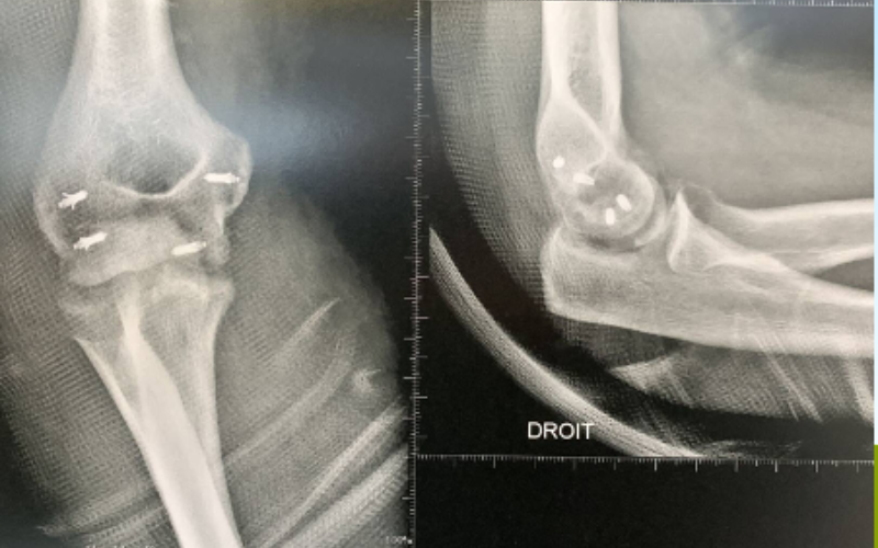 radiographie après ligamentoplastie