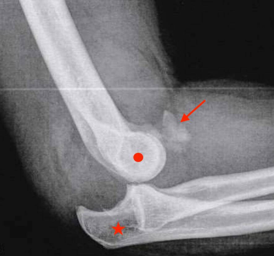 Radiographie d'une luxation postéro-latérale du coude