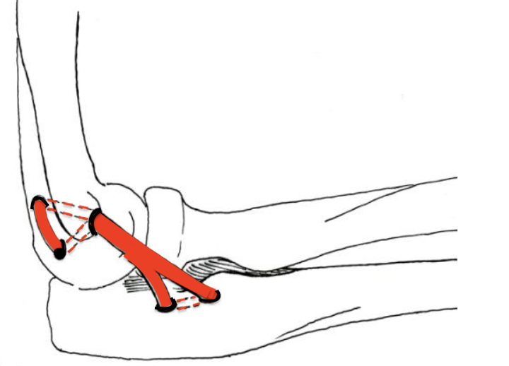 Schéma de la ligamentoplastie du coude