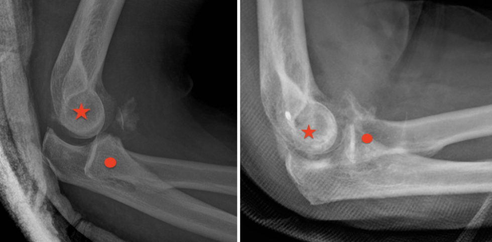Radiographie avant et après la ligamentoplastie du coude