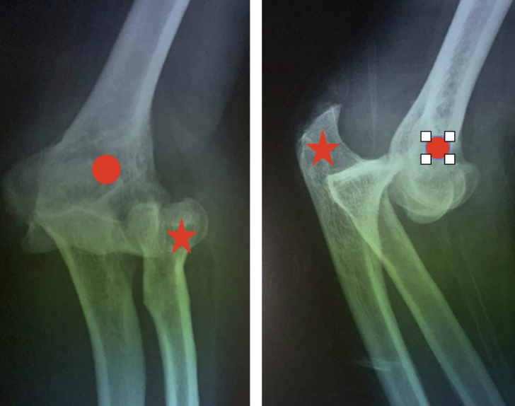 radiographie d'une instabilité postero-latérale