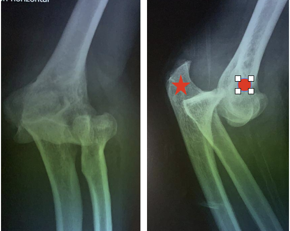 luxation et instabilité postero-latérale du coude radiographie