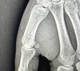 radiographie d'une entorse du pouce