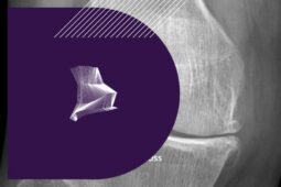 gonarthrose tricompartimentale comment soigner une gonarthrose femoro-tibiale comment soigner une gonarthrose du genou clinique drouot clinique du genou paris