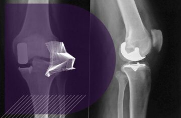 prothese unicompartimentale genou complications chirurgie genou paris clinique drouot