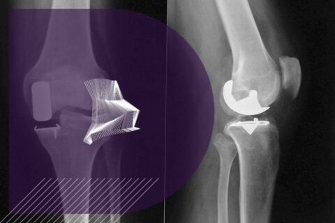prothese unicompartimentale genou complications chirurgie genou paris clinique drouot